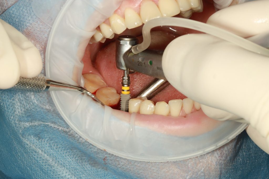 types of dental implants